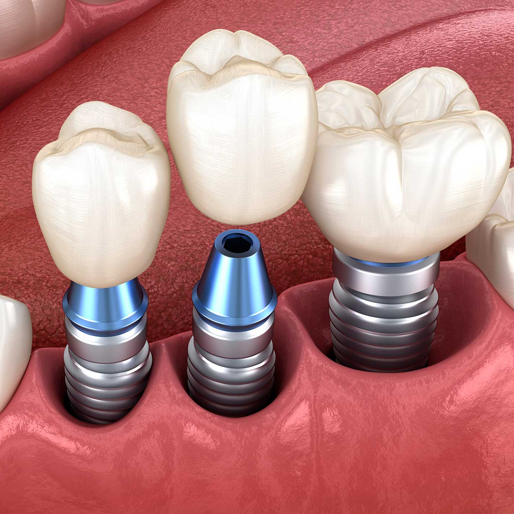 Implanturi dentare